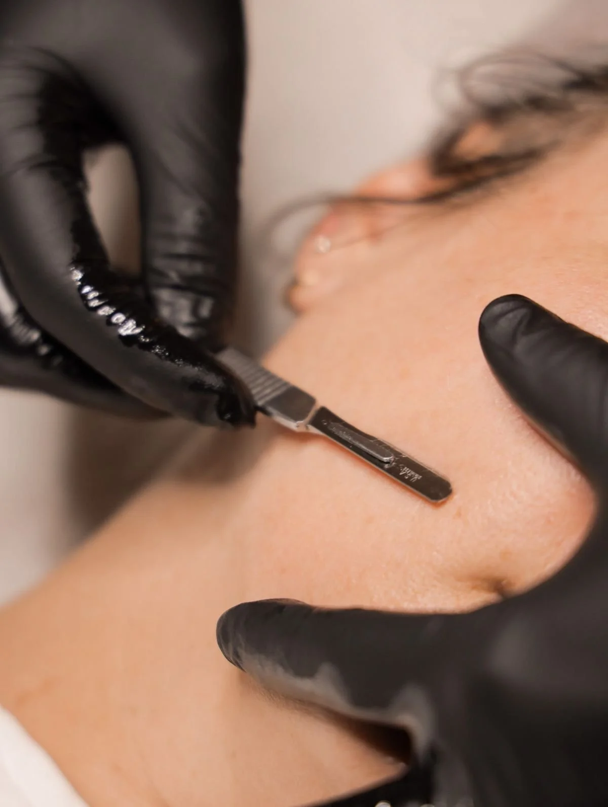 Professional dermaplane treatment being performed on skin