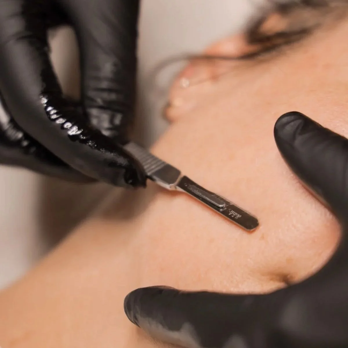 Professional dermaplane treatment being performed on skin.