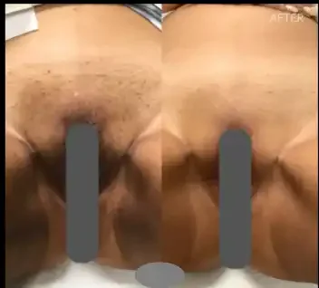 Close-up of a person's lower back and buttocks before and after a skin treatment, showing improvement in skin texture.