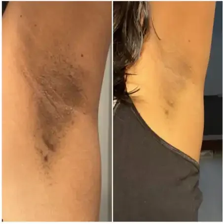 Side-by-side images of an armpit showing significant skin improvement, from dark, rough skin to smoother, lighter skin.
