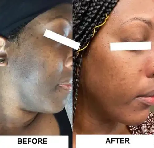 Side-by-side comparison of a woman's face showing skin improvement, labeled 'Before' on the left and 'After' on the right.