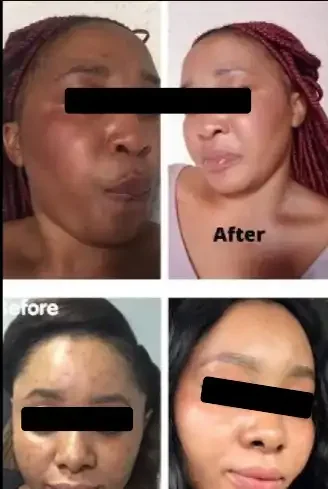 Side-by-side comparison of women's faces showing before and after facial transformations, with the 'after' images appearing clearer and more refined.