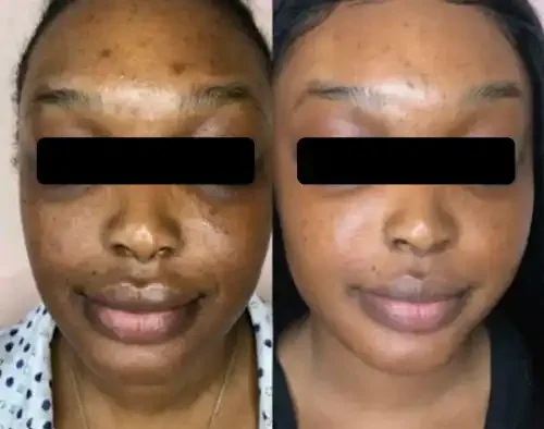 Before and after images of a woman showing the improvement in skin condition, with reduced dark spots and clearer complexion.