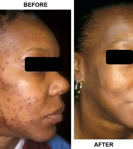 Comparison showing a woman's face before and after skin treatment, with improved skin texture and reduced blemishes in the after photo.