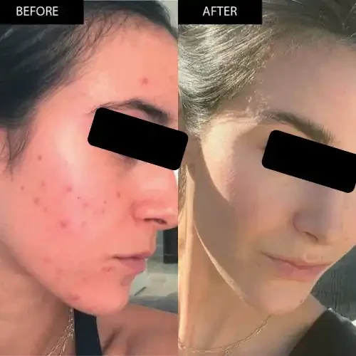 Side-by-side before and after photos of a woman showing clear skin improvement, with the 'before' side displaying acne and blemishes, and the 'after' side showing smooth, clear skin.