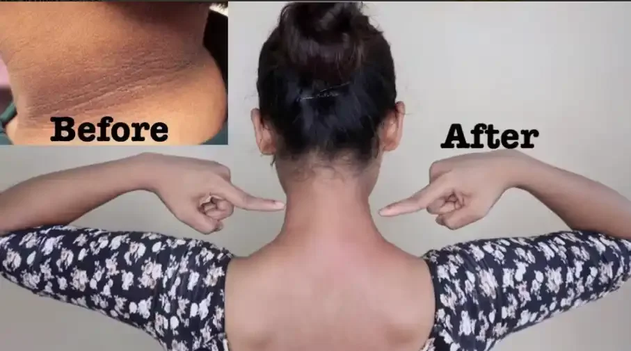Comparison of a person's back before and after a treatment or procedure, with insets showing close-up of the skin's surface in the 'Before' section and the person's back with arms raised in the 'After' section.