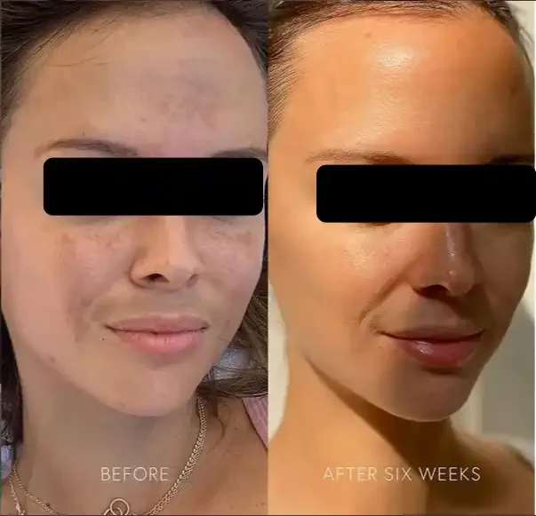 Side-by-side comparison of a woman's face before and after six weeks of skincare, showing clearer, smoother skin in the after photo.