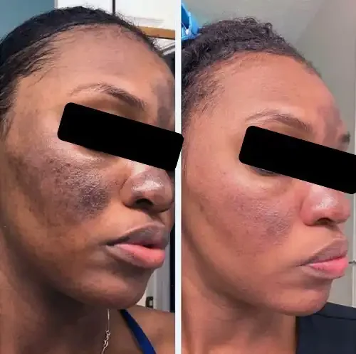 Side-by-side comparison of a woman with skin damage and scarring on the left, and clearer skin with reduced scarring on the right.