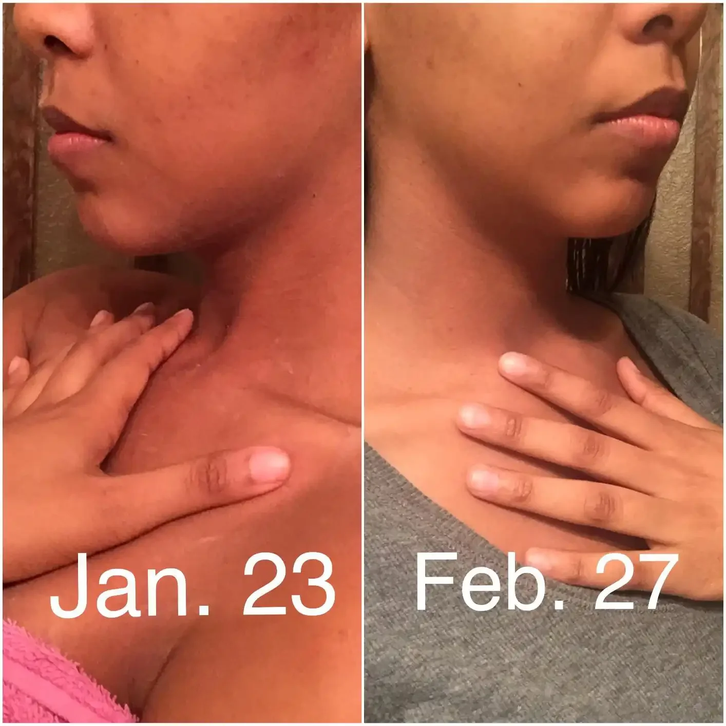 Side-by-side comparison of a woman's face and neck in two photos, with dates Jan. 23 on the left and Feb. 27 on the right, showing skin improvement over time.