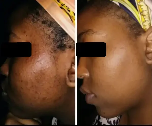 Side-by-side comparison of a woman's face before and after skincare treatment, showing significant reduction in acne and skin scarring.