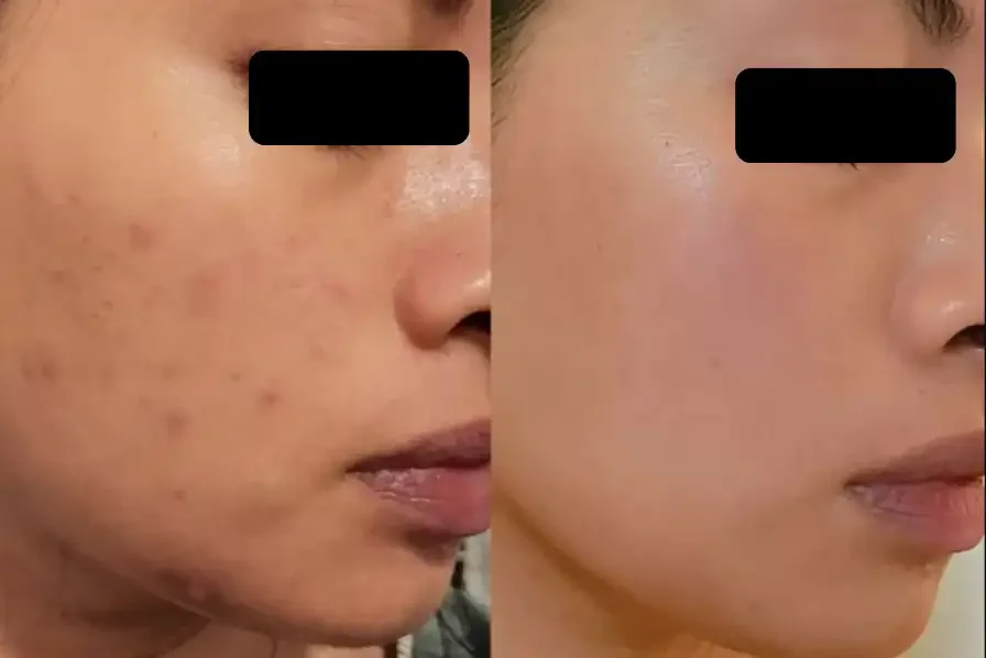 Comparison of a woman's face showing acne and post-treatment clear skin.