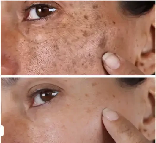 Close-up of a person's face showing before and after skin treatment, focusing on freckles or dark spots.