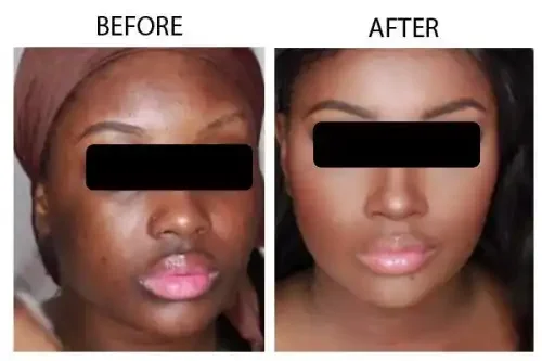 Side-by-side comparison of a woman's face before and after skincare or makeup, showing clearer, more even skin in the after photo.