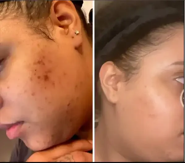 Side-by-side comparison of a woman's cheek showing severe acne and scarred skin on the left, and clear, smooth skin on the right.