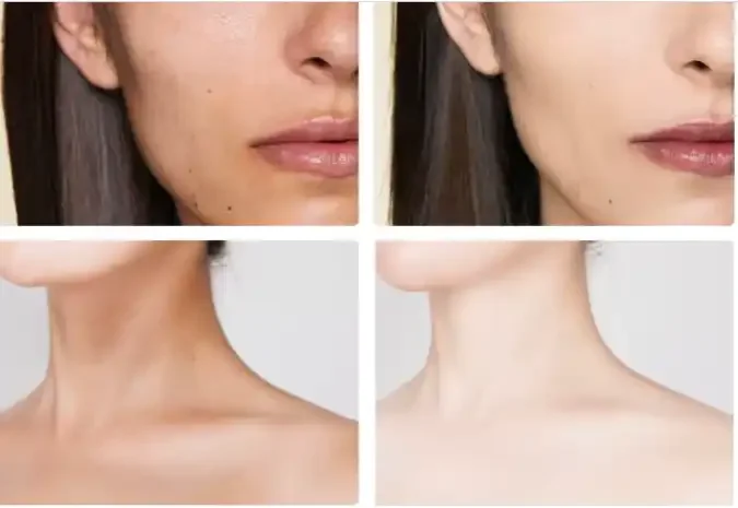 Before and after images showing improved skin and clearer complexion, focusing on lips and neck areas.