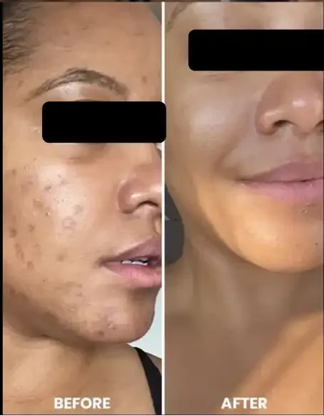 Side-by-side comparison photo of a woman's face, showing acne and blemishes before skincare treatment and clear, smooth skin after treatment.