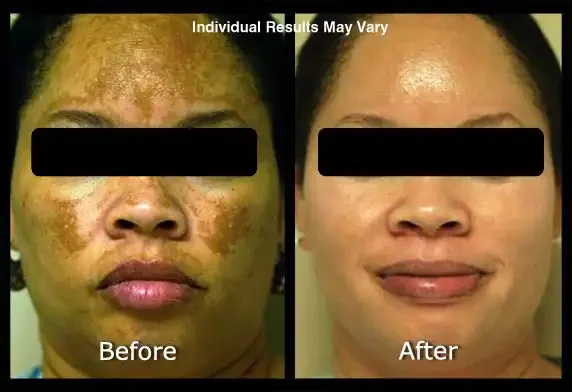 Side-by-side comparison of a woman's face showing severe pigmentation and uneven skin tone before treatment on the left, and clear, evenly toned skin after treatment on the right.