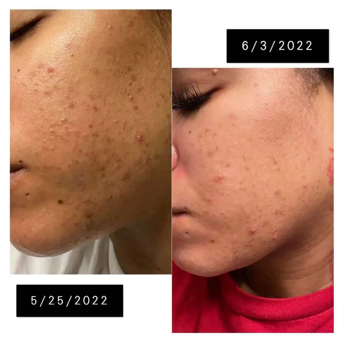 Before and after images showing improvement in skin acne and hyperpigmentation over time, with dates 5/25/2022 and 6/3/2022.