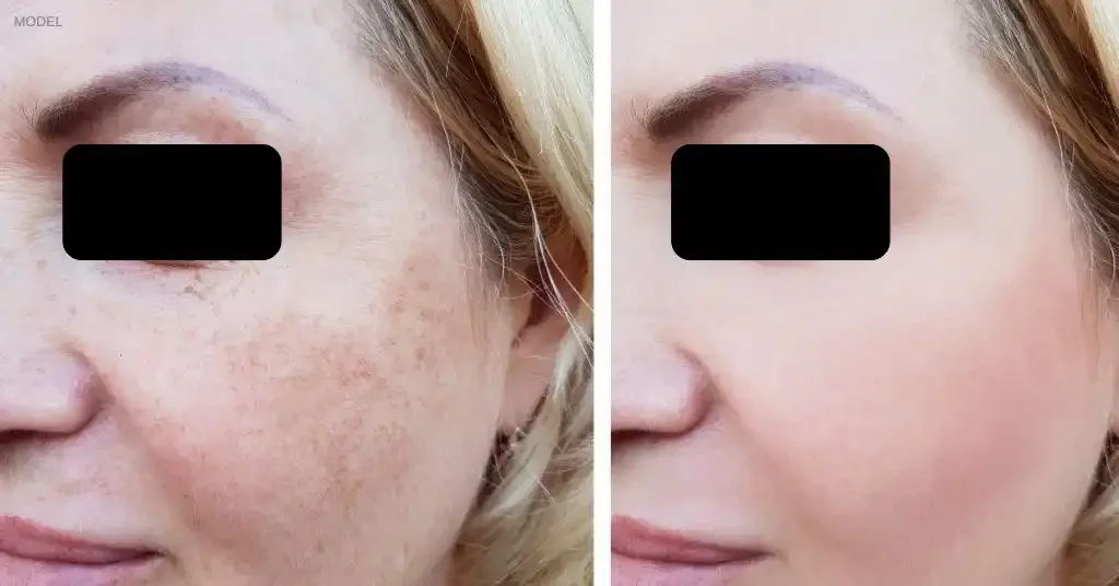 Side-by-side comparison of a woman's face, showing before and after skincare treatment. The left side shows hyperpigmentation and uneven skin tone; the right side shows a clearer, brighter complexion.