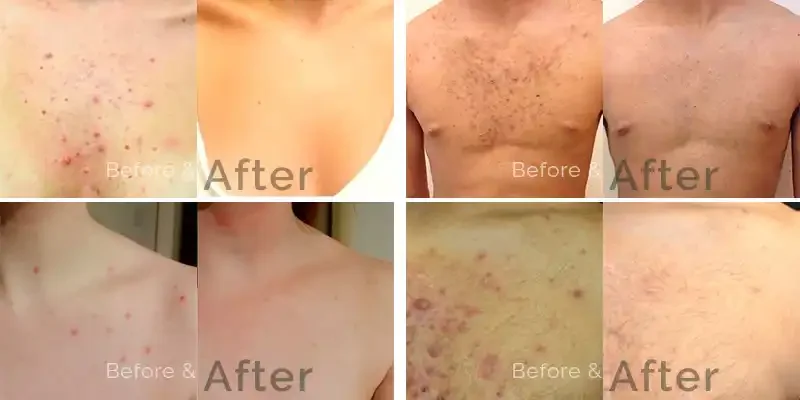 Collection of skin before and after images showing reduced acne, scars, and blemishes.