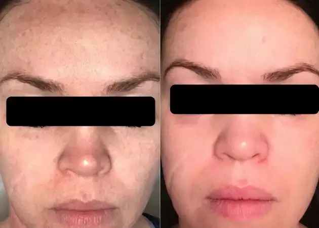 Side-by-side comparison of a woman's face before and after skin treatment, showing improved skin clarity and reduced acne.