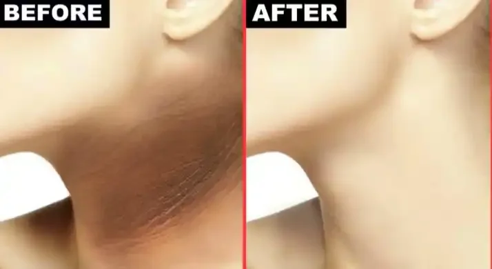 Side-by-side comparison of armpits showing hair removal before and after treatment.