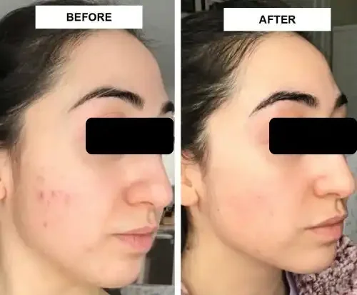 Side-by-side comparison of a woman's face showing skin before and after treatment, with clearer skin after.