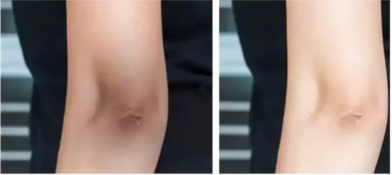 Comparison of a person's knee before and after treatment, showing reduced swelling and inflammation in the after image.