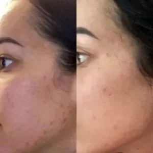 Close-up comparison of a person's cheek before and after skin treatment, showing reduced dark spots and improved skin clarity.