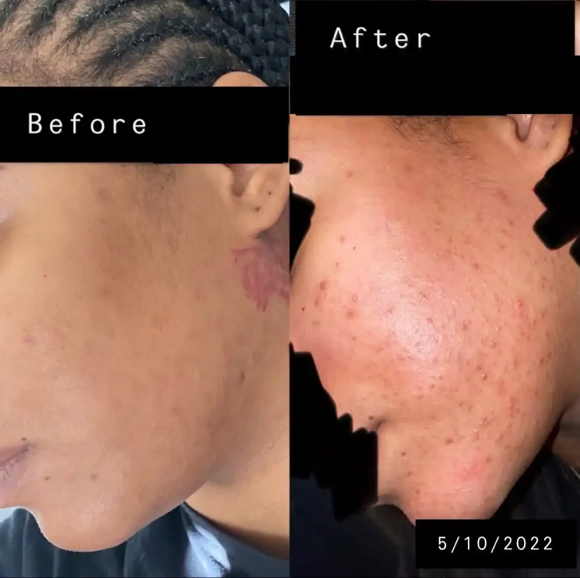Close-up side profile of a person's cheek showing skin before and after a skincare treatment, with visible improvements in skin texture and complexion, dated 5/10/2022.
