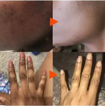 A collage of two close-up images showing hands with split skin, with an arrow pointing from the damaged skin to a healed, healthy-looking hand.
