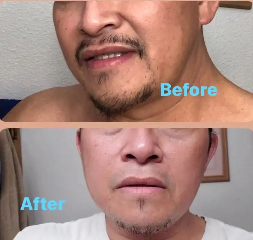 Comparison photo showing a man's lower face and neck before and after skincare. The "Before" image shows an older man with facial hair and some skin imperfections. The "After" image shows a younger-looking man with smoother skin and less facial hair.