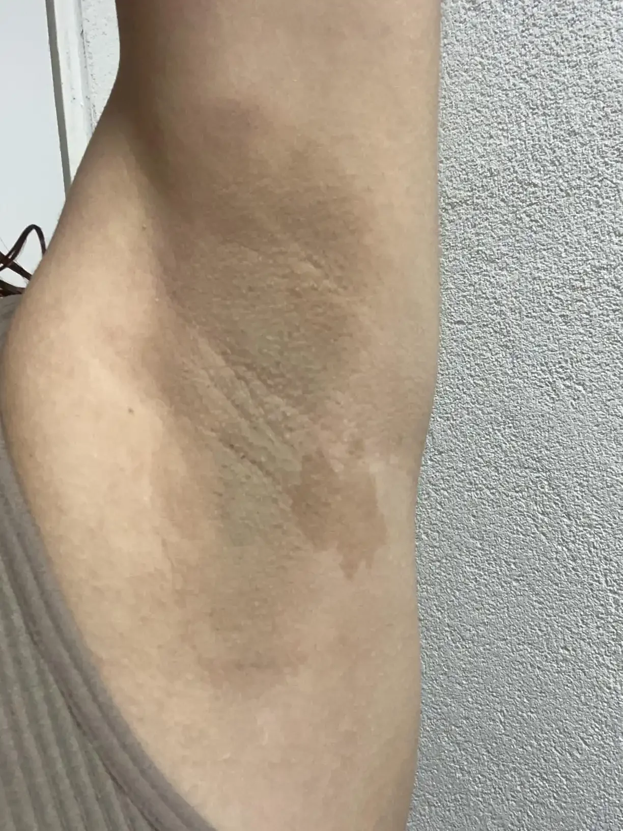 Close-up of a person's armpit showing dry and textured skin against a textured wall background.