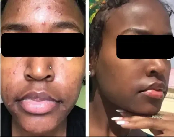 A side-by-side comparison of a woman showing her face before and after skin treatment, with visible improvement in skin clarity and texture.