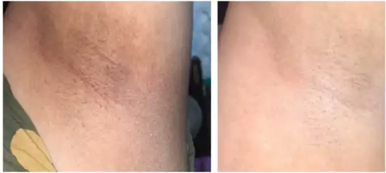 Comparison of underarm skin showing reduction in hyperpigmentation or uneven skin tone.