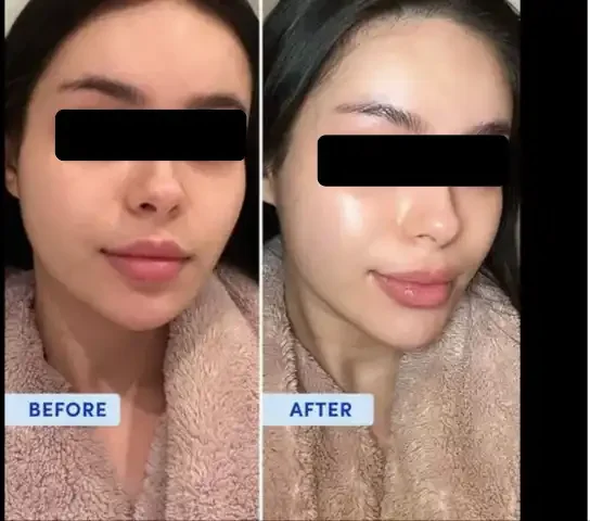Side-by-side comparison of a woman before and after skincare or cosmetic treatment, with the words 'BEFORE' and 'AFTER' at the bottom of each image.