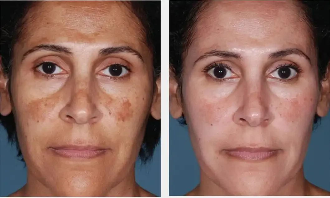 Side-by-side comparison of a woman's face before and after skincare treatment showing reduced hyperpigmentation and even skin tone.