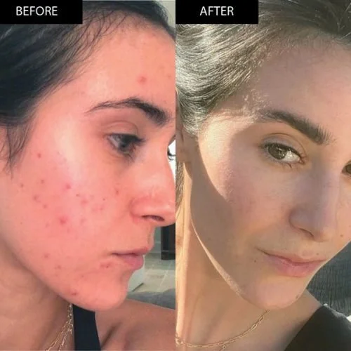 Side-by-side comparison of a woman’s face showing acne with redness and blemishes before and clear skin after treatment.