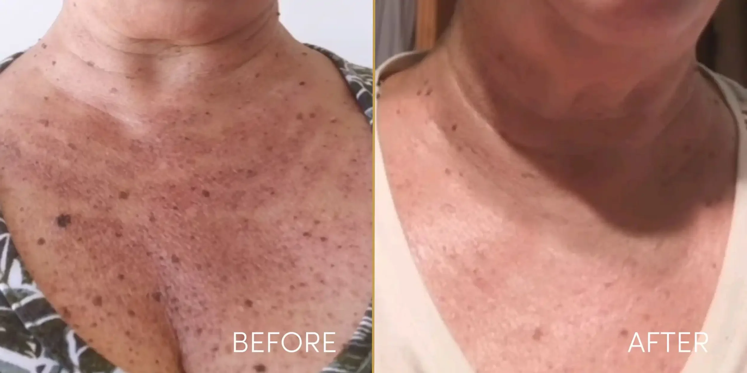 Side-by-side comparison of a person's shoulder before and after skin treatment, showing reduced pigmentation and spots in the after image.