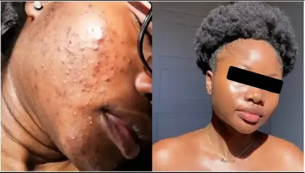 Comparison of a woman’s face with severe acne scars and skin improvement after treatment.