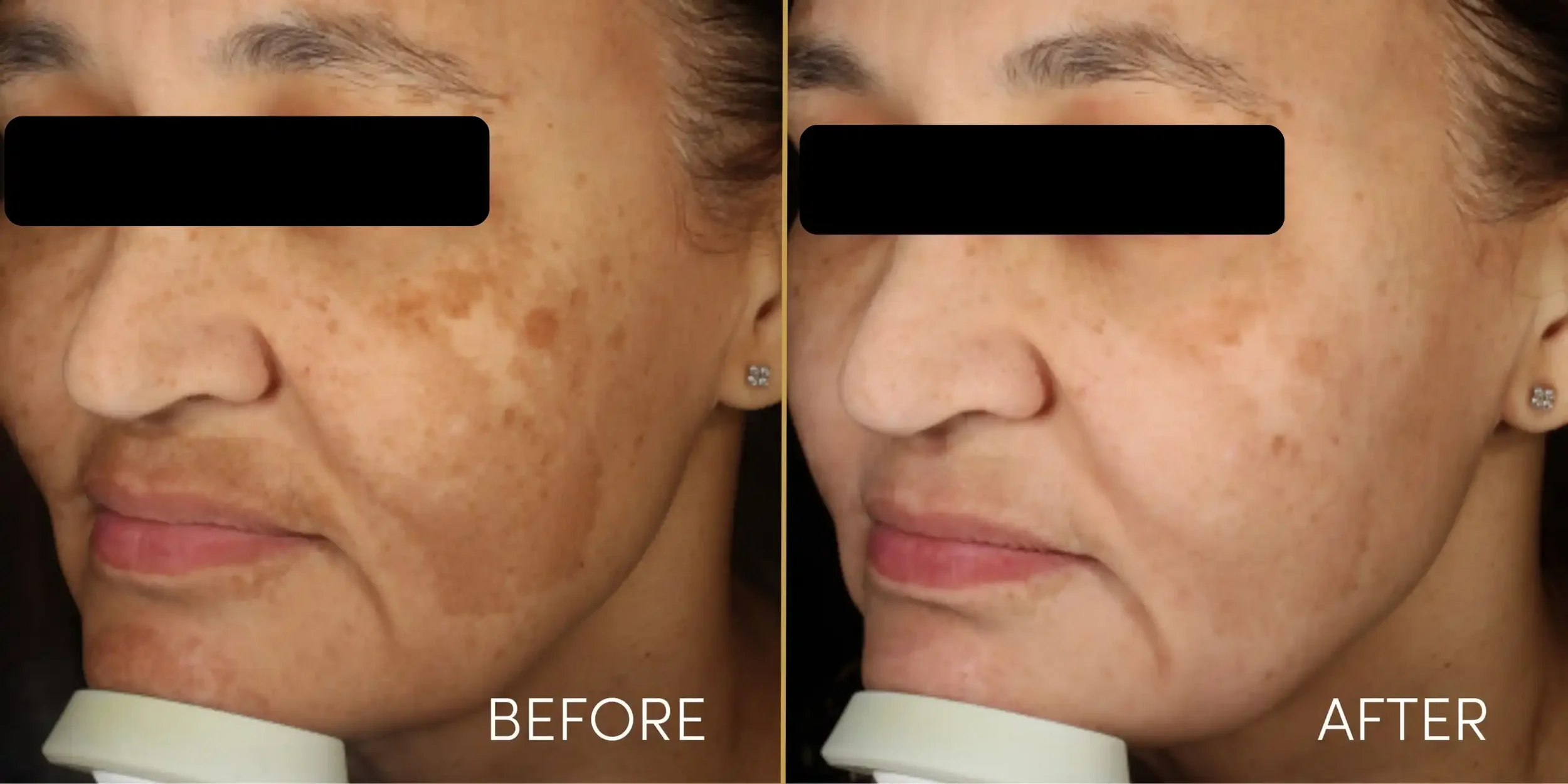 Side-by-side comparison of a woman’s face showing a reduction in dark spots and freckles before and after skincare treatment.