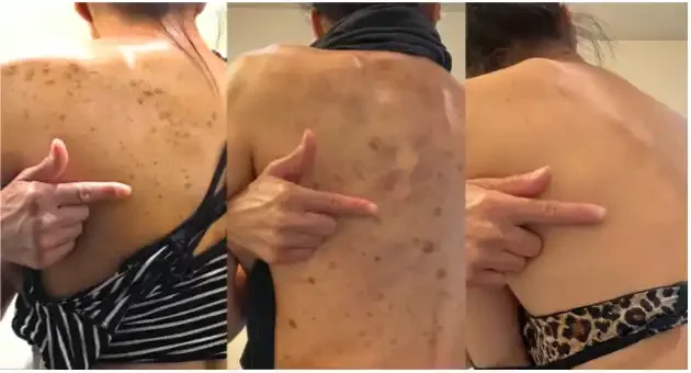 Three side-by-side images of a woman's back showing different stages of skin irritation or rash, with her pointing to the affected areas.