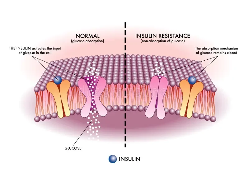 Diagram comparing normal and insulin-resistant cell membranes, showing how insulin activates glucose intake in normal cells but is blocked in insulin resistance.