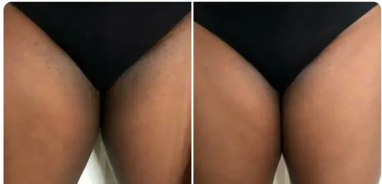 Comparison of thighs showing reduction in skin discoloration or pigmentation.
