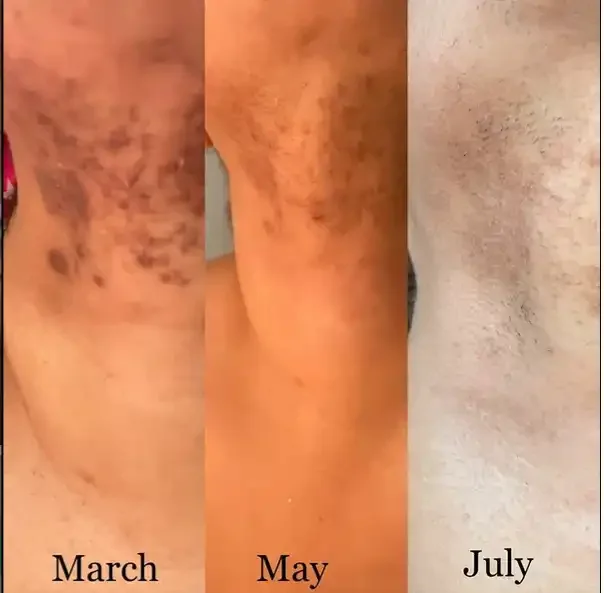 Progression of skin healing on a person's arm from March to July, showing gradual reduction of bruising and discoloration over time.