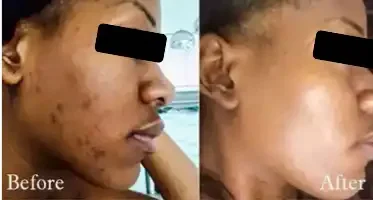 Side-by-side comparison of a woman's face showing facial acne before and after treatment, with noticeable improvement in skin clarity and texture.