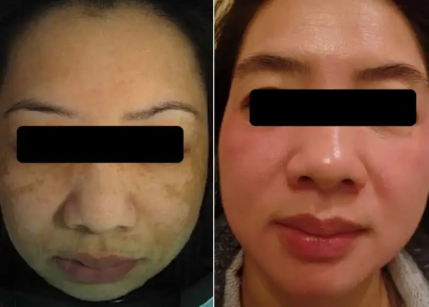 Side-by-side photos of a woman's face before (left) and after (right) facial treatment showing clear skin with reduced spots and blemishes.