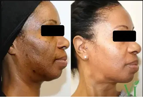 Side-by-side comparison of a woman before and after skincare treatment showing improved skin clarity and texture