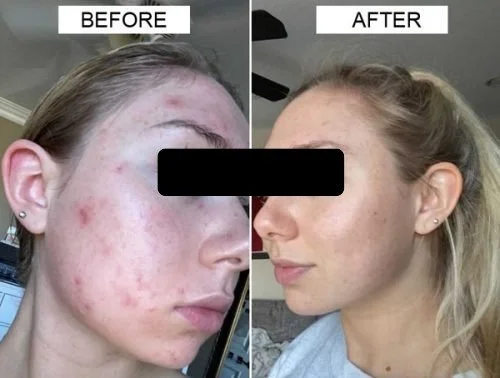 Side-by-side comparison of a woman's face showing acne before and after treatment, with the "before" side displaying significant acne and the "after" side showing clear skin.