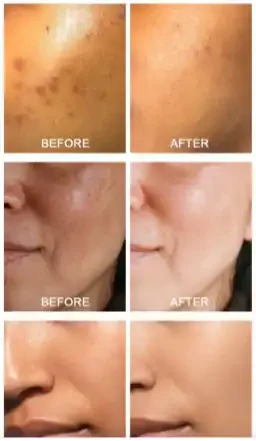 Comparison images showing a person's skin before and after treatment, with visible improvement in skin clarity and reduction of dark spots.